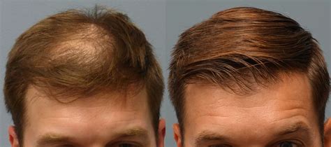 Before And After Neograft Hair Transplant Hair Restoration Savannah