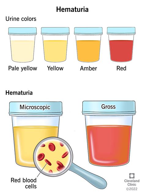 Red Blood Cells And White Blood Cells In Urine
