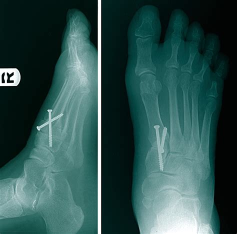 Why The Lapidus Procedure Is Ideal For Bunions