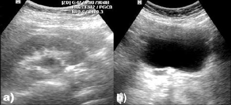 Ultrasound Images For A 10 Mm Stone In The Right Upj Causing Mild