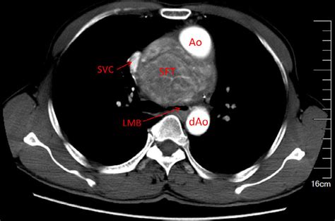 Thoracic Computed Tomography Ct Scan Showing A Giant Mediastinal Mass