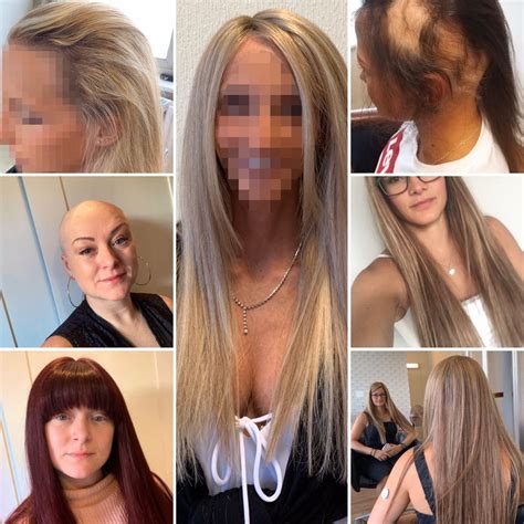 Hair loss in women has many causes. Pin by Hair Solved on Before and After in 2020 | Hair loss ...