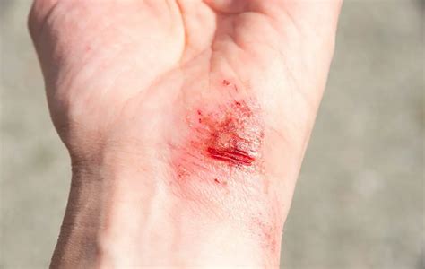 Dry Wounds Explained Causes And Effective Care Tips