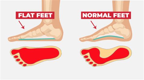 29 Quick Solutions That Every Runner With Foot Pain Need To Know