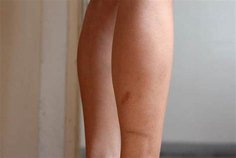 Read on to know more about how to treat wound scars permanently. How to Remove Scars on Legs?