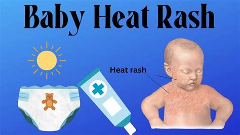 Baby Heat Rash Causes Treatment And Home Remedies