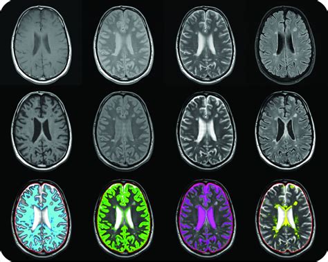 Clinical Feasibility Of Synthetic Mri In Multiple Sclerosis A