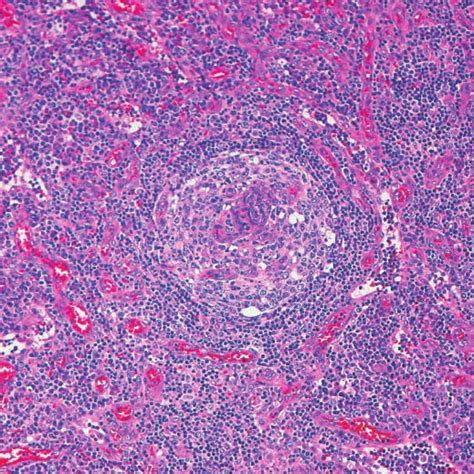Hyaline Vascular Variant Castlemans Disease With Mantle Cell Lymphoma