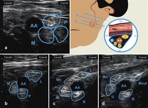 Fascial Layers Influence The Spread Of Injectate During Ultrasound
