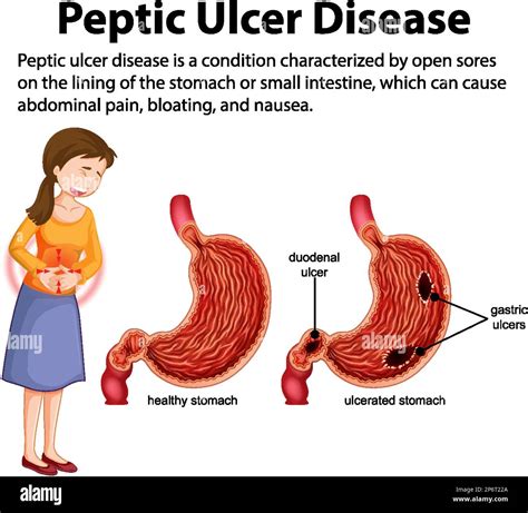 Peptic Ulcer Disease Infographic Illustration Stock Vector Image And Art