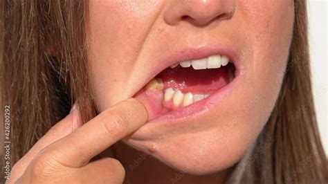 Young Woman Showing Her Mouth Without Tooth On Lower Jaw Missing Tooth Or No Tooth Waiting An