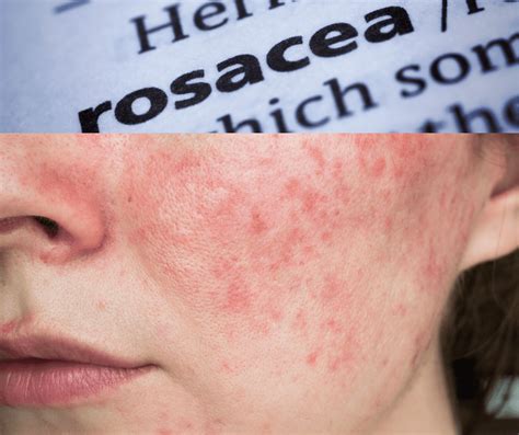 What Causes Rosacea Helen Cleland