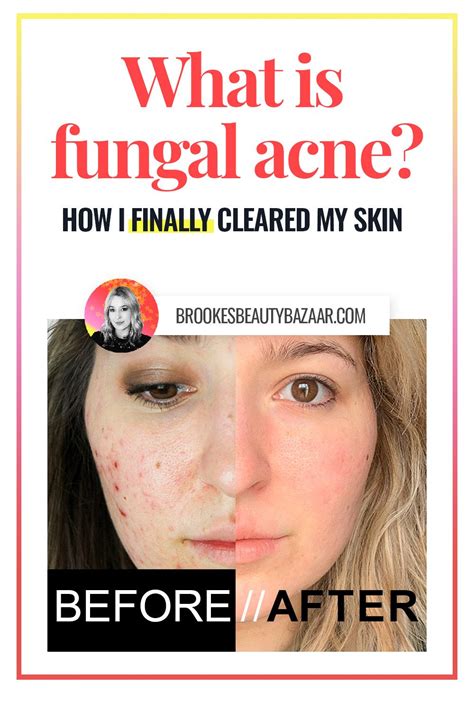 How To Clear Your Type Of Acne With Skincare Products Artofit