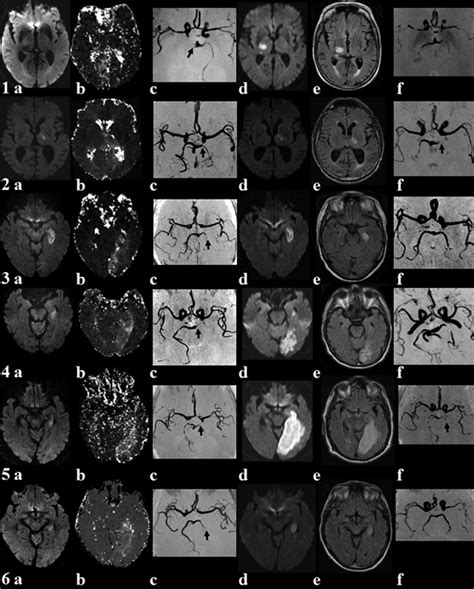 Mr Imaging In Posterior Circulation Stroke Before Ac And After Df