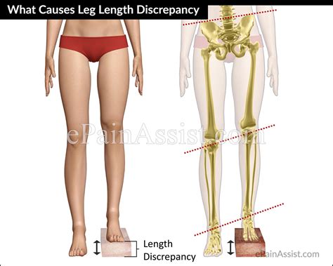 It is also important to determine whether your back pain is more. What Causes Leg Length Discrepancy & What are its Symptoms ...