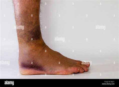 Ankle Sprain With Black And Blue Bruising On White Background Stock