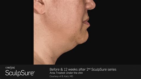 Laser Body Contouring Before And After Sculpsure