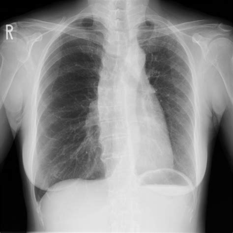E Chest Radiograph Posteroanterior Pa View From Case 1 Shows A Small