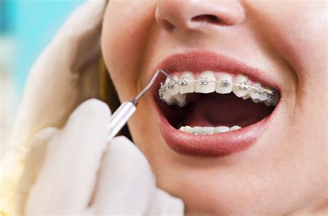 What Is The Best Age To Start Orthodontic Treatment Downey Ca