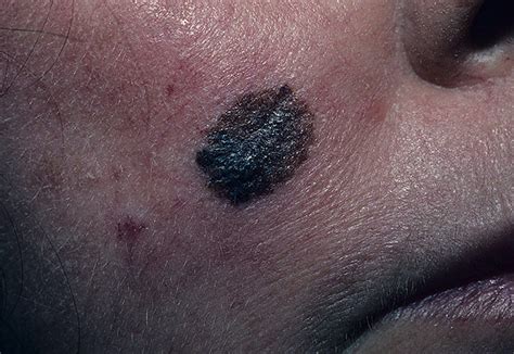 Melanoma On Face Pictures Photos Images Illnessee Com