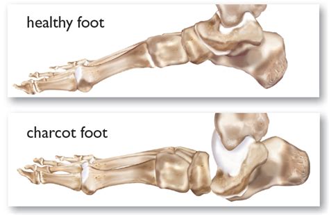 What Is Charcot Foot Sporting Life Arkansas