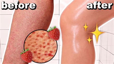How To Get Rid Of Strawberry Legs In One Day Get Rid Of Keratosis