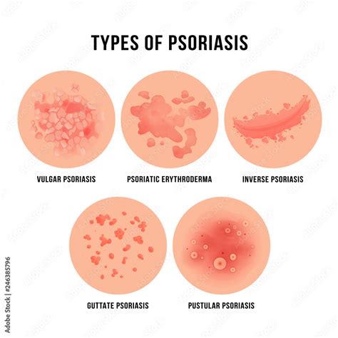 Psoriasis Skin Disease Types Of Derma Problem Stock Vector Adobe Stock