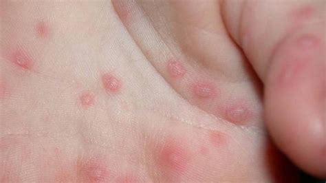 Hand Foot And Mouth Disease Confirmed And A Primary School In Sydneys West Daily Telegraph