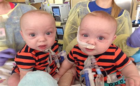 Conjoined Twins Separated And Finally Leaving Hospital · Guardian