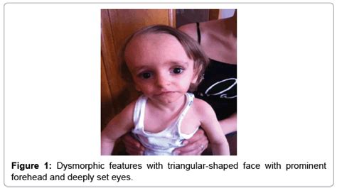 Clinical Case Reports Dysmorphic Features