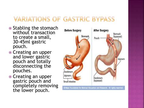Gastric Bypass Surgery Pictures