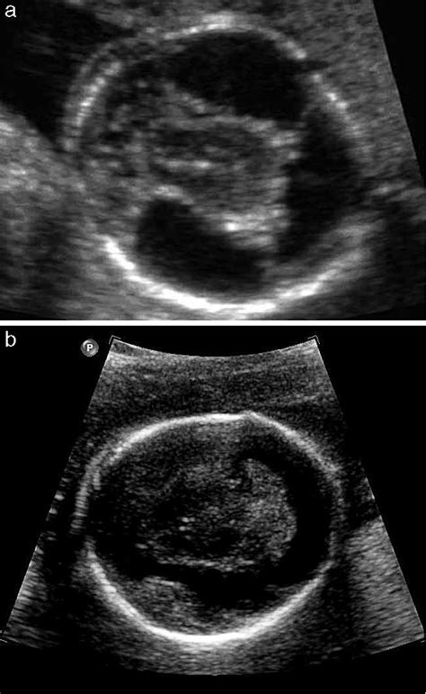 A Ultrasound Of A Child With Cleft Lip And Palate B Threedimensional