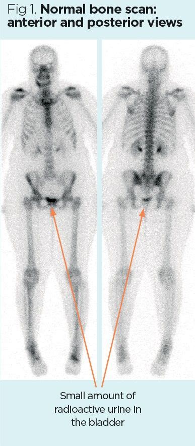 Nuclear Medicine 2 Principles And Technique Of Bone Scintigraphy