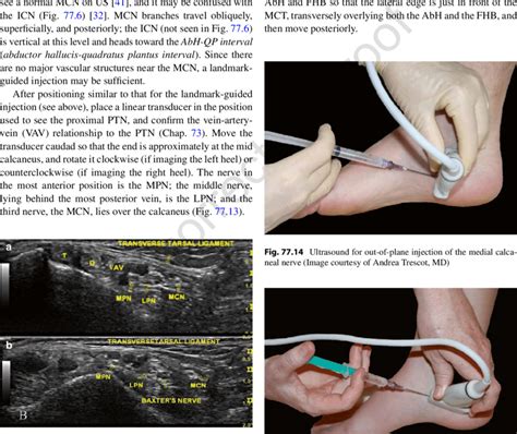 13 Ultrasound Location Of The Medial Calcaneal Nerve T Posterior