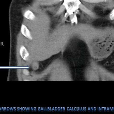 Ct Scan Abdomen Arrows Showing Large Gallbladder Calculas With