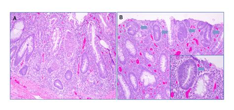 Cureus Refractory Fulminant Colitis Requiring Surgical Intervention