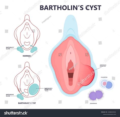 11 Bartholin Cysts Images Stock Photos Vectors Shutterstock