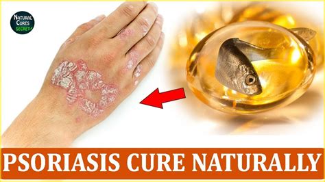 How To Cure Psoriasis Naturally Psoriatic Arthritis Treatment At Home