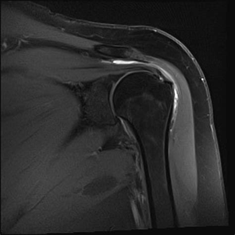 Subdeltoid Bursitis Mri