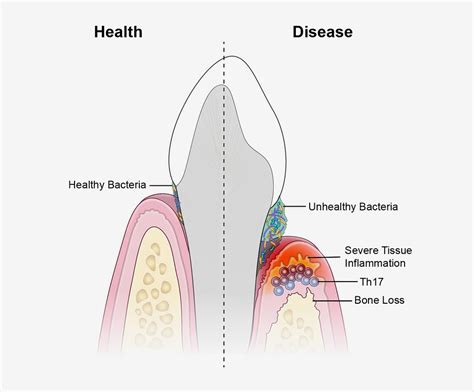What Is Periodontal Disease Loop Perio Chicago Periodontists And Implants