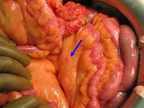 Check spelling or type a new query. HIPEC mesothelioom mesothelioma