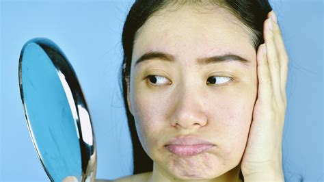Whiteheads Vs Blackheads What S The Difference And How Can You Get