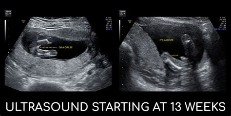13 Weeks Pregnant Ultrasound Gender Pregnant Twins