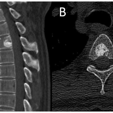 A Sagittal Reformation Ct B Axial Ct Rounded Sclerotic Lesion In