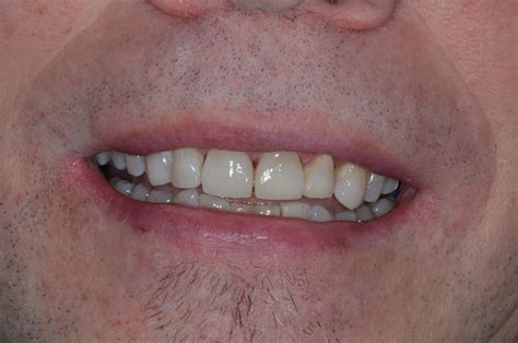I need a tooth pulled and have insurance at work. Gallery - Composite Resins Bonding - Uptown Guelph Dental