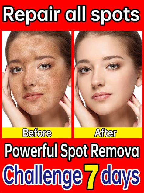 Freckles Removal Essence Remove Facial Spots Skin Dark Spot Remove