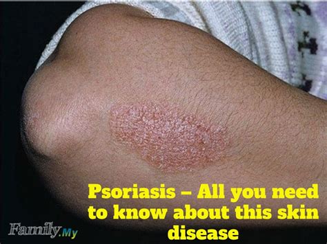 Is Psoriasis Skin Disease Contagious