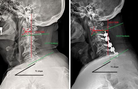 Pre A And Postoperative B 3 Months X Ray Assessment Of Cervical