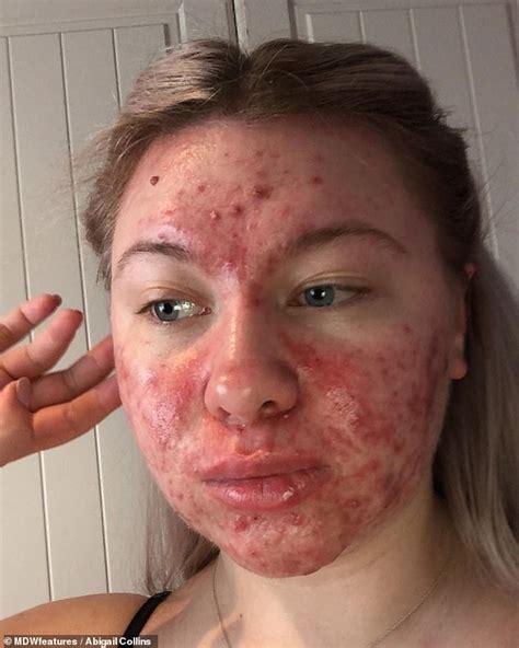 Student With Severe Acne Refuses To Date Fearing Men Will Feel