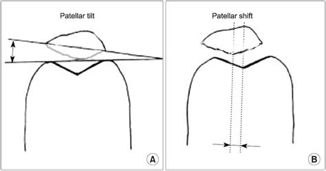 A Comparison Of The Midvastus And Median Parapatellar Surgical